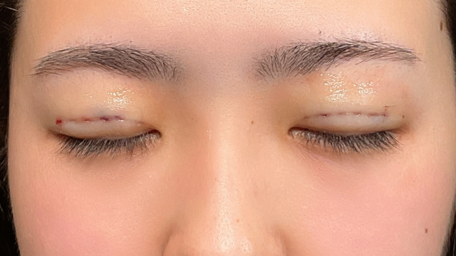 手术前的状态 其一