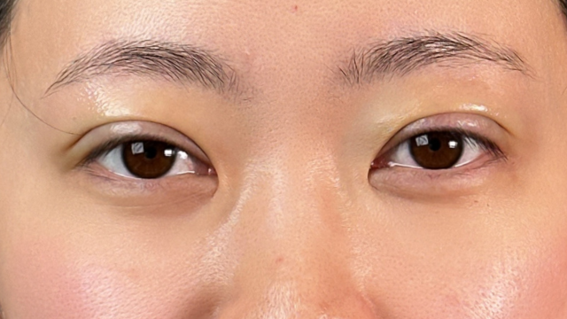 手術前の状態 その1