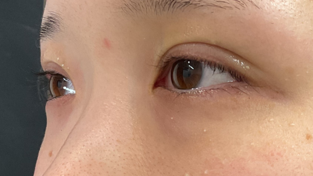 手術前の状態 その1