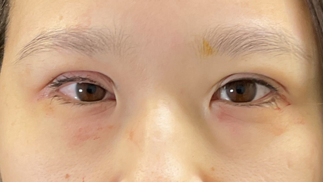 手术前的状态 其一