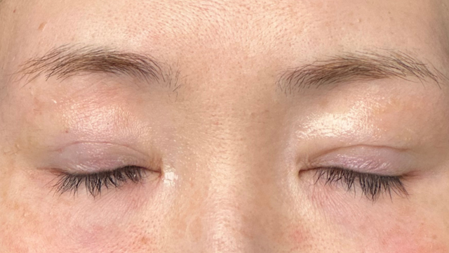 手術前の状態 その1