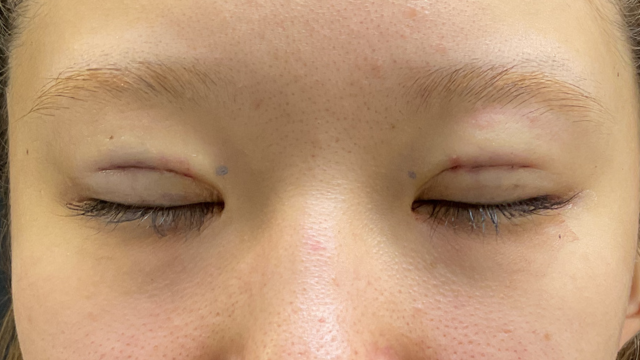 手術前の状態 その1