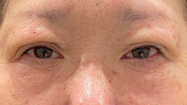 手术前的状态 其一