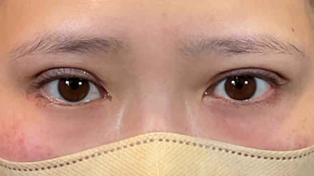 手术前的状态 其一