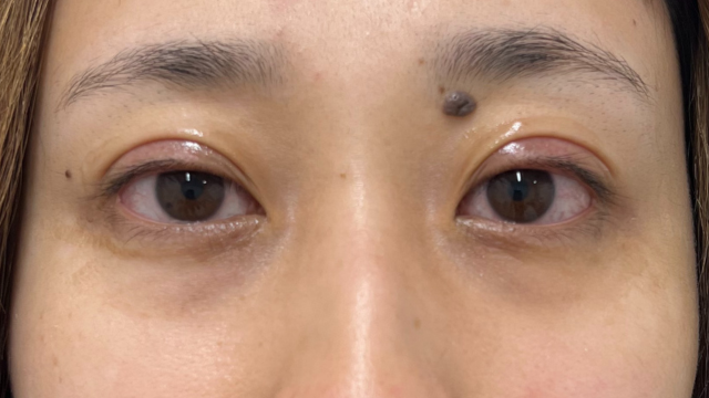 手术前的状态 其一