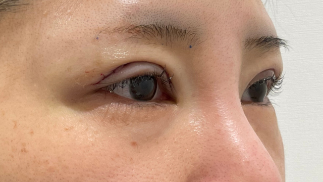 手術前の状態 その1