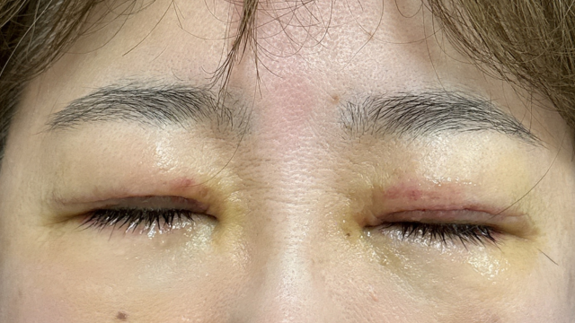 Postoperative Condition Part 1