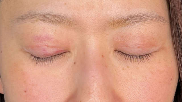 手术前的状态 其一