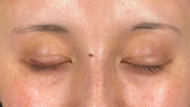 手术前的状态 其一