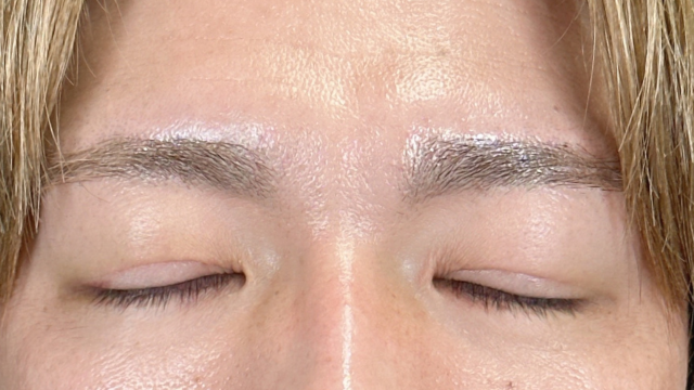 手術前の状態 その1