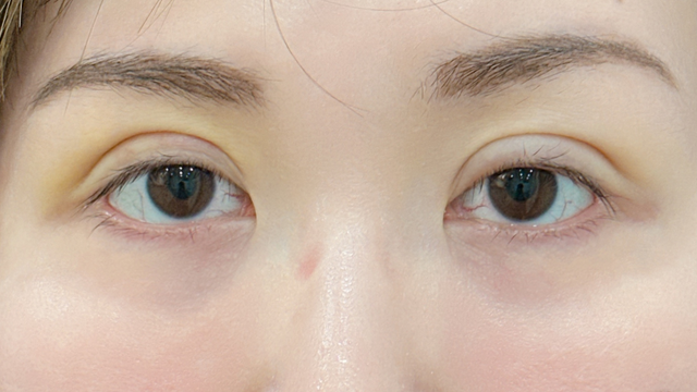 Postoperative Condition Part 1