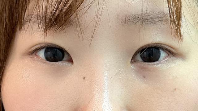 手术前的状态 其一