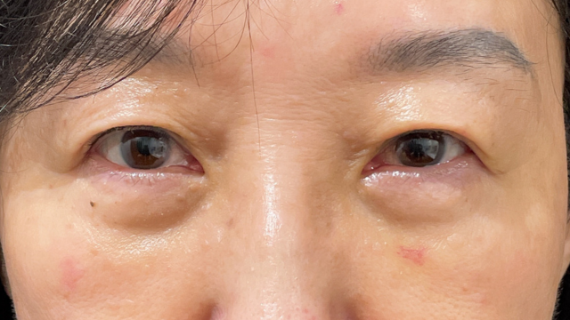 手术前的状态 其一