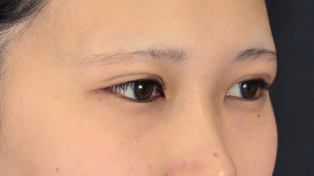 手術前の状態 その1