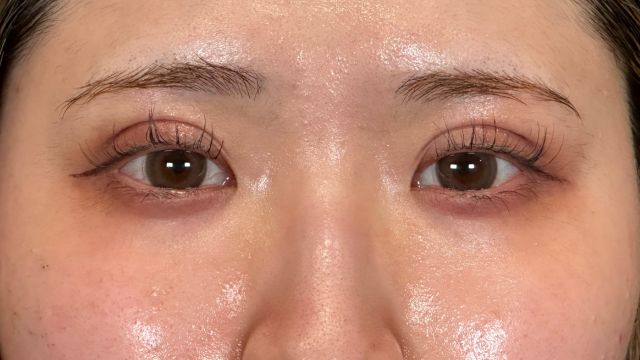 手術前の状態 その1