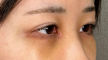 手術前の状態 その1