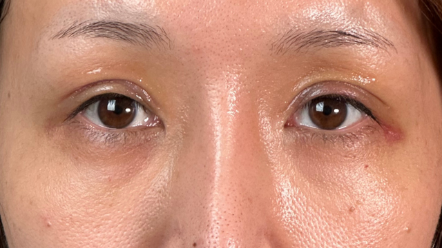 手術前の状態 その1