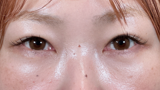 手术前的状态 其一