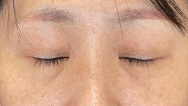 手术前的状态 其一