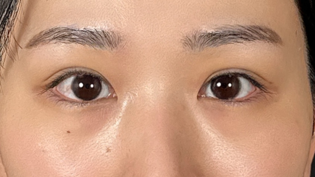 手術前の状態 その1