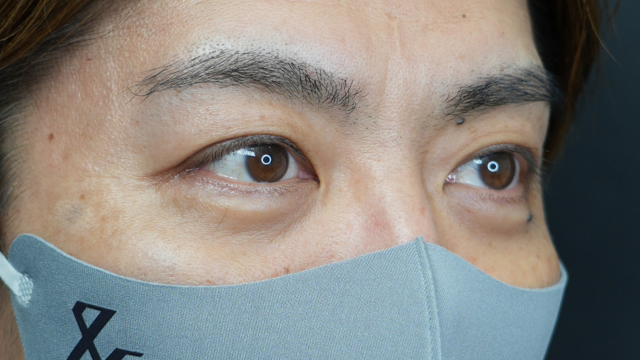 手術前の状態 その1