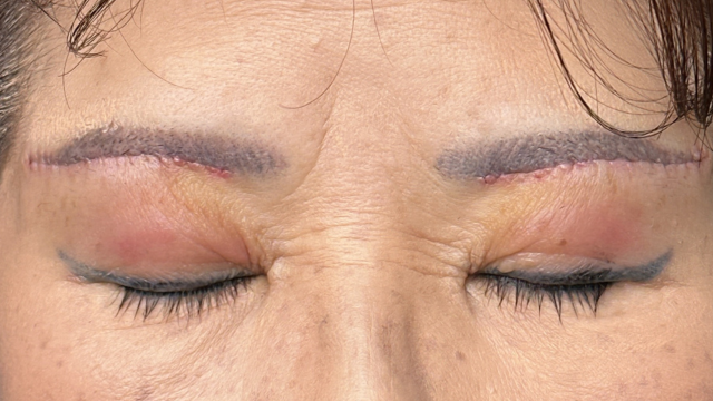 Postoperative Condition Part 1