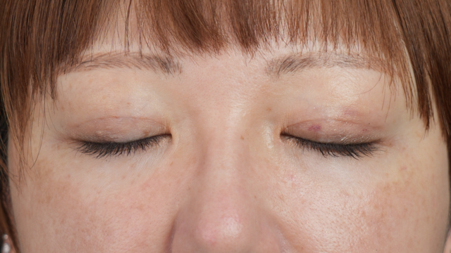 手术前的状态 其一