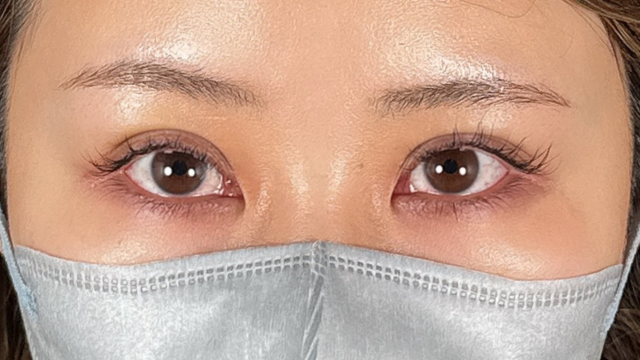 手术前的状态 其一