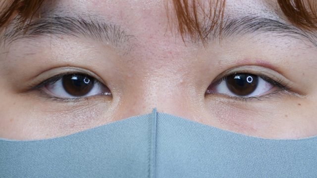 手术前的状态 其一