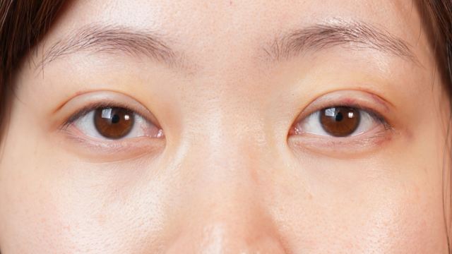 手術前の状態 その1