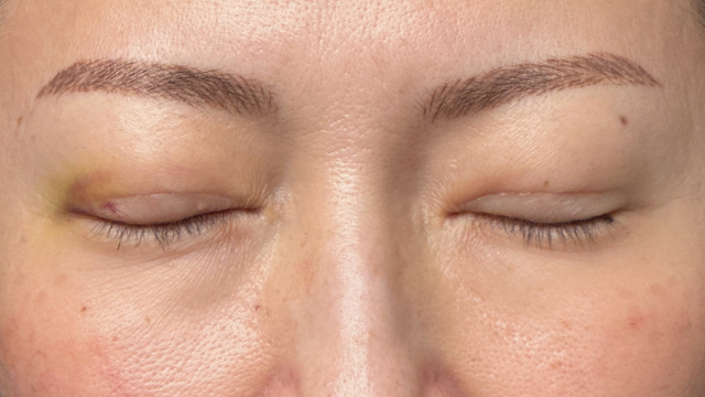 手术前的状态 其一