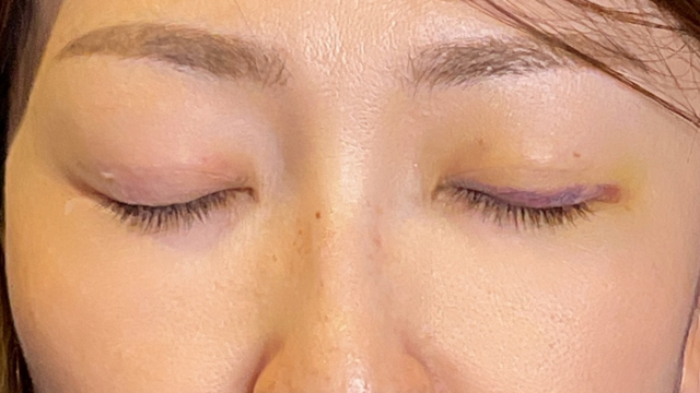 手术前的状态 其一