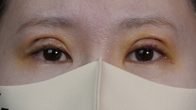 手術前の状態 その1