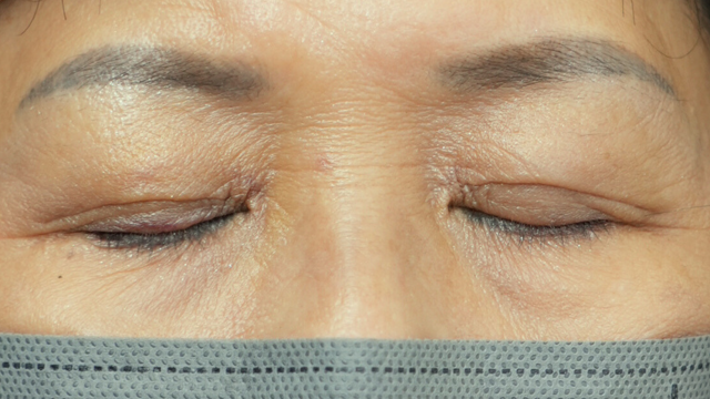 手术前的状态 其一