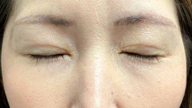 Postoperative Condition Part 1