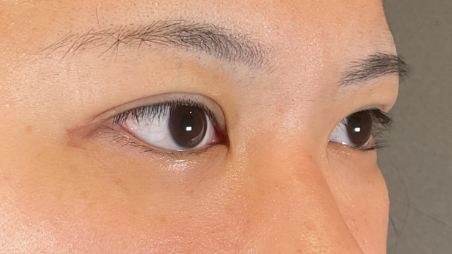 手术前的状态 其一