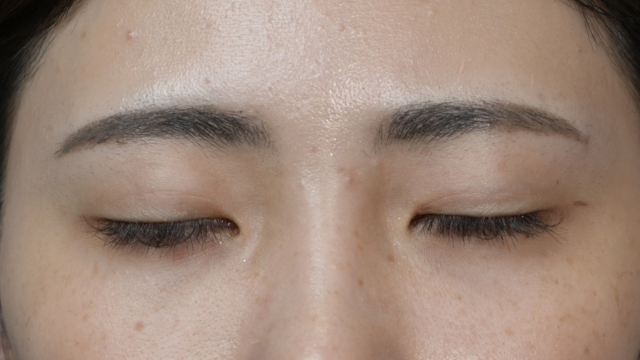 Postoperative Condition Part 1