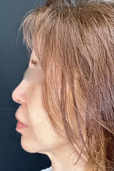 手術前の状態 その1