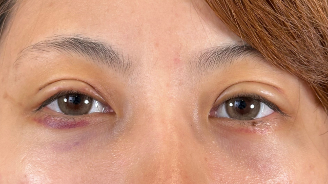 手術前の状態 その1