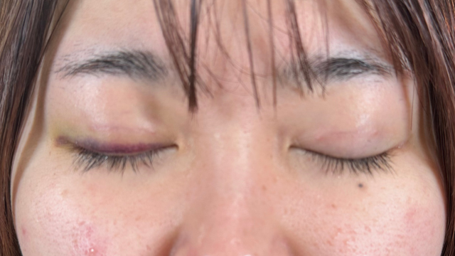 手术前的状态 其一