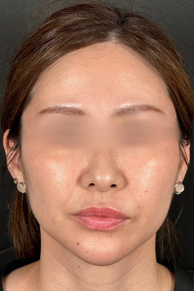 手术前的状态 其一