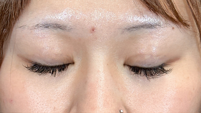 手术前的状态 其一