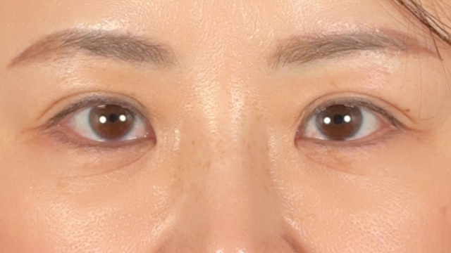 手术前的状态 其一