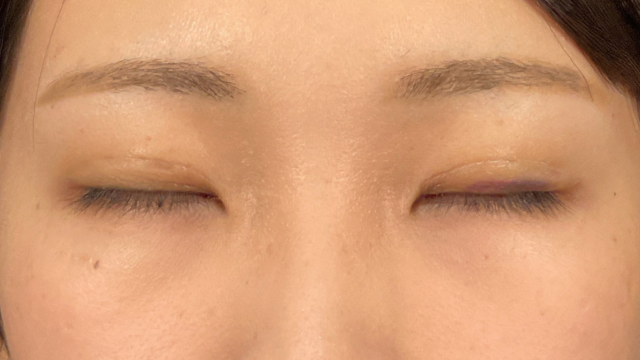 手術前の状態 その1