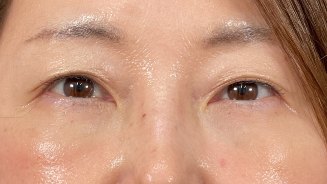 手术前的状态 其一