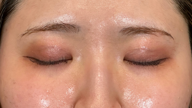 手術前の状態 その1