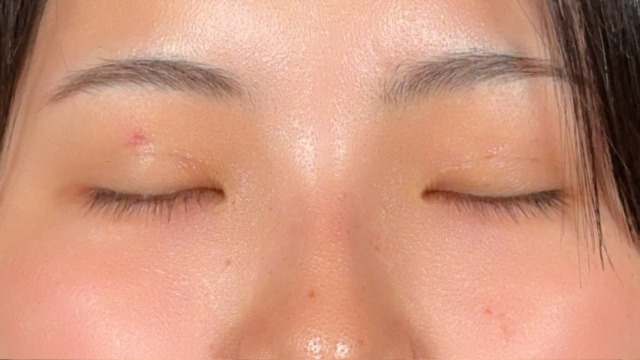 手术前的状态 其一