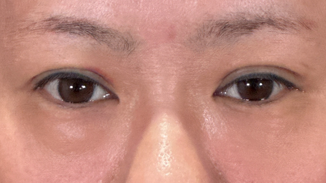 Postoperative Condition Part 1