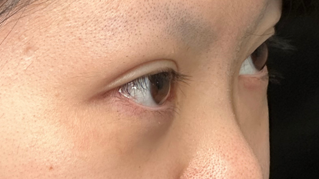 手术前的状态 其一