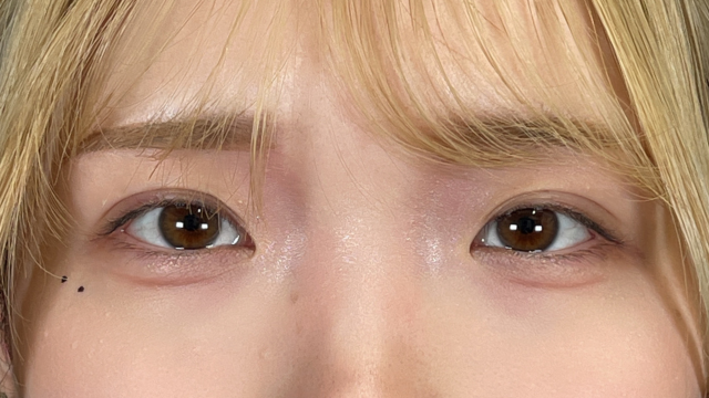 手術前の状態 その1